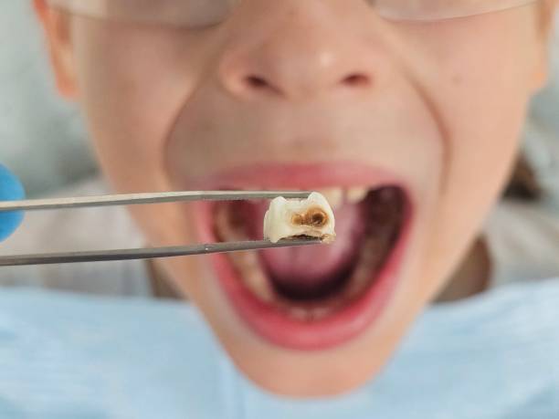 Best Emergency Dentist for Lost Fillings or Crowns in Brooksi, DE